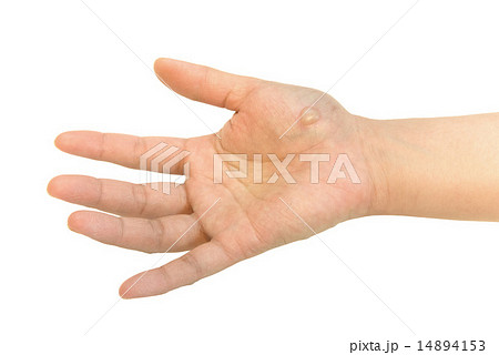 水ぶくれ 火傷の写真素材 水ぶくれ 火傷の写真素材