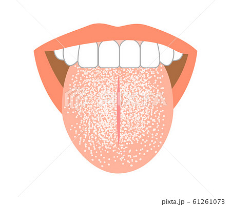 舌癌の写真素材 - PIXTA