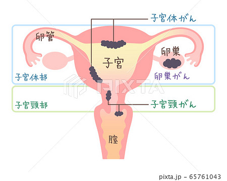 卵巣ガンのイラスト素材