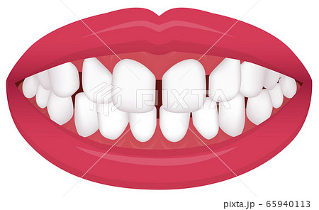 すきっ歯のイラスト素材