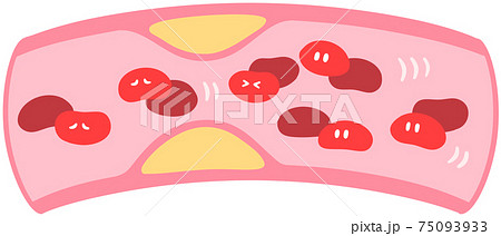 動脈硬化のイラスト素材