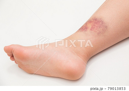 打撲痕の写真素材