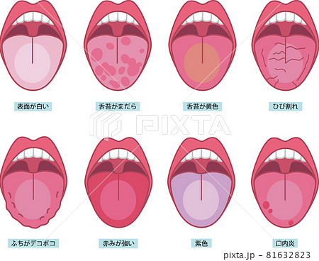 舌苔のイラスト素材