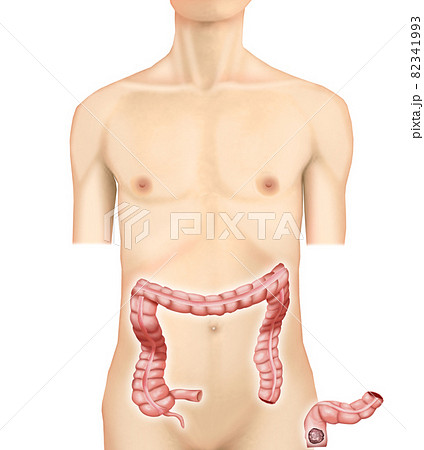 ストーマのイラスト素材